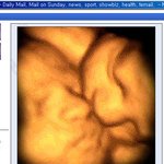 엄마 자궁서 ‘키스하는’ 쌍둥이 태아 초음파 촬영