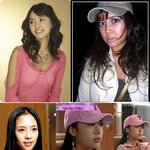 연예인 얼굴 지방주입 <b>전후</b>