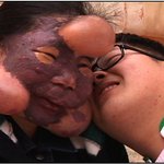 호랑이 아줌마 조귀목씨 혈관종 안타까운 <b>사연</b>