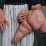 세손가락 <b>무게</b>만 10kg나가는 사나이..