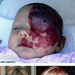 얼굴의 반이 붉은 <b>반점</b>이었던 소녀