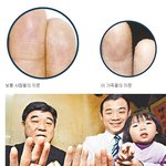 5대에 걸쳐서 <b>손발</b>에 지문이 없는 가족