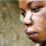 <b>콩고</b>에서 수술하면 이렇게 된다..(약간 징그러우니 놀라지마요!)