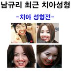 남규리 최근 <b>치아</b>성형