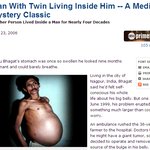 36년동안 쌍둥이 형제를 <b>뱃속</b>에서 키운 남자