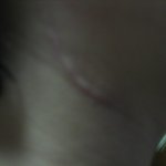 경락마시지 받고 임파선이 부어 수술했어요..(사진포함)