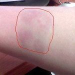 친구가 제 팔 물어서 멍들었어요