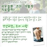 피부질환 "<b>건선</b>" 어떻게 치료할까?