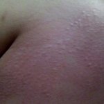 (사진有) 피부묘기증..아세요?정말괴로워죽겠습니다ㅜ.ㅜ