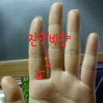 손가락 사이가..점점..갈라져요 (사진有)