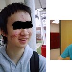 여드름땜에 친구들이 자꾸 놀려요ㅠㅠ스트레스엄청받음;