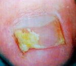 손발톱<b>무좀</b> 예방 및 치료법 faq