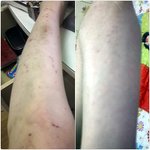 (사진有)술취한 아저씨 때문에 풀독 오른 사건 ㅠㅠ