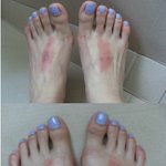 분노게이지 상승 !!! t자모양 샌들신었더니 발등에 그대로 <b>발진</b> 올라..