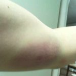 [사진有]<b>대천</b> 디스코(타가다)를 타다가 다친 상처,