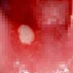 [사진다수有]구내염.. <b>알보칠</b>을 아시나요?