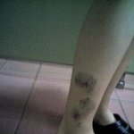 선천성 혈관종. 저도 원피스에 샌달신고 싶어요