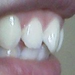 ★사진有)치아교정후 <b>재발</b>ㅡㅡ