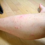 사진有)개학 하루 전에 모기에게 다리만 120방 이상 물렸어요 ㅠㅠ