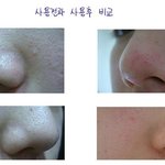 블랙헤드 없애는 새로운 방법