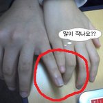 손가락이 이상해요 (사진 有)