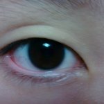 (사진 有)<b>안검</b>하수 괴로우시죠ㅠ.ㅠ..쌍커풀후깁니다!