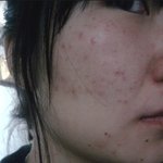 여드름흉터와 여드름자국때문에 고민이었던 나! 저처럼피부관리하세요~