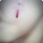 [사진有/혐오有] 성인여드름 해결책을 알려주세요 ㅜㅜ