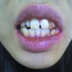 치아교정으로 <b>이빨</b> 빼다가 앞니가 깨졌어요(사진有)