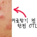 25년 굴욕 인생 여드름치료하고 대박 <b>훈녀</b>로 거듭났어요.(사진有)