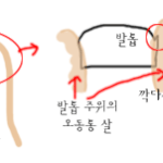 <b>엄지</b>발톱이 계속 살을 파고 들어요!!