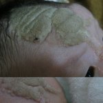 신생아인데, 얼굴에 큰점이 있어요..도와주세요..