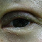 쌍꺼풀 <b>재수술</b>했어요 좀 봐주세요 급해요.