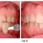 불만제로에 소개된 치아성형의 진실 (잇몸<b>염증</b>)