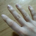 [사진有]얼굴경락하다가 손가락 잃을 뻔한