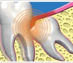 사랑니 <b>발치</b> 이렇게 하세요~