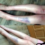 멍들고, <b>usb</b>분실하고.. 운 없었던 하루