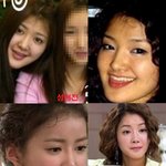 이시영 성형전 vs 성형후