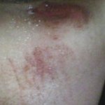 넘어져서 생긴 얼굴<b>흉터</b> (사진/有)