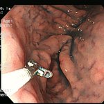 <b>위암</b>의 판정에 대하여........