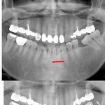 (사진有) 어금니교정하려다 앞니가 틀어짐