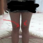 [사진첨부] 이런 다리..무릎 손잡이 살을 아세요??ㅜㅠ