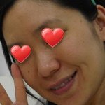 출산후 <b>기미</b>치료하고 피부대박!