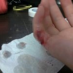 버스에서 다친 손가락 버스에서 치료받았어요