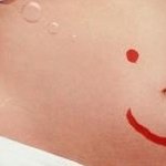 <b>복부</b>튼살, 종아리튼살, 가슴튼살 -튼살치료에 대한 오해와 주의사항