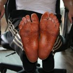 흑인이 되버린 내 <b>발바닥</b>(사진有)
