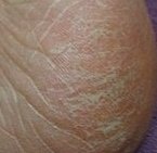 <b>무좀</b>으로 고생하고 있답니다! <b>무좀</b>크림으로 발이 많이 좋아졌어요!