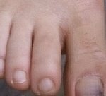 무더운 여름철을 더욱 악화시키고 있는 <b>무좀</b>! <b>무좀</b> 어떻게 하지??