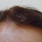 ★(사진有)새로운 <b>헤어라인</b>을 주신 원장님★