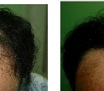 넓은이마 때문에  <b>모발</b>이식 했는데  할만 하네요